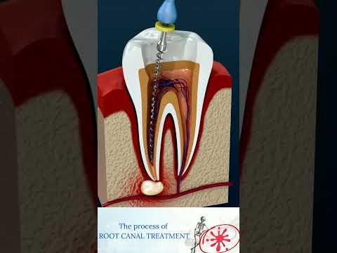 Root Canal Treatment & Tooth Abscess thumbnail