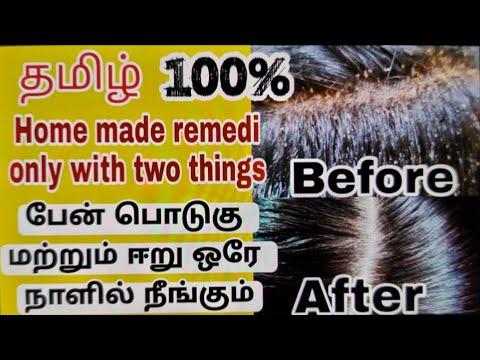 Remove lice from hair in Tamil/How to get rid of head lice and nits/lice treatment at home thumbnail
