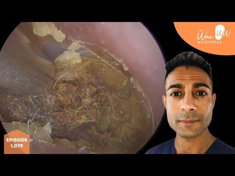 1,079 - Crusted Ear Wax Removal off Eardrum thumbnail
