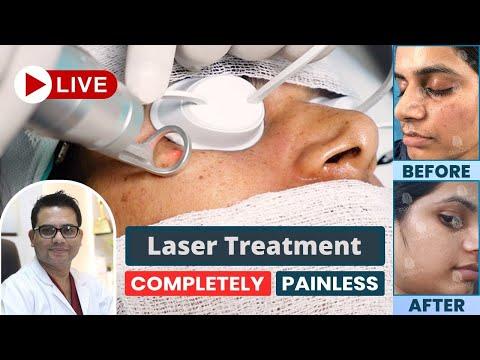 Freckles Laser Treatment |  Best Freckles Laser Treatment in Delhi NCR |  SkinQure | Dr Jangid thumbnail